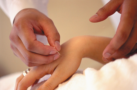 acupuncture