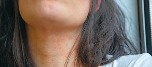 Alt: Text description of hormone imbalance affectant la peau fragile du cou, cause d'irritation et d'inflammations fréquentes, nécessitant des soins spécifiques.